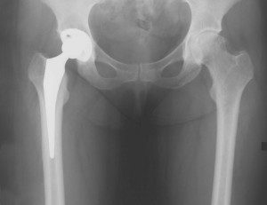Anterior-approach-Total-Hip-Replacement